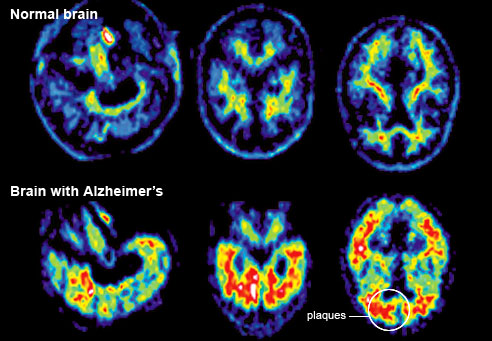 Doença de Alzheimer pode ser contagiosa